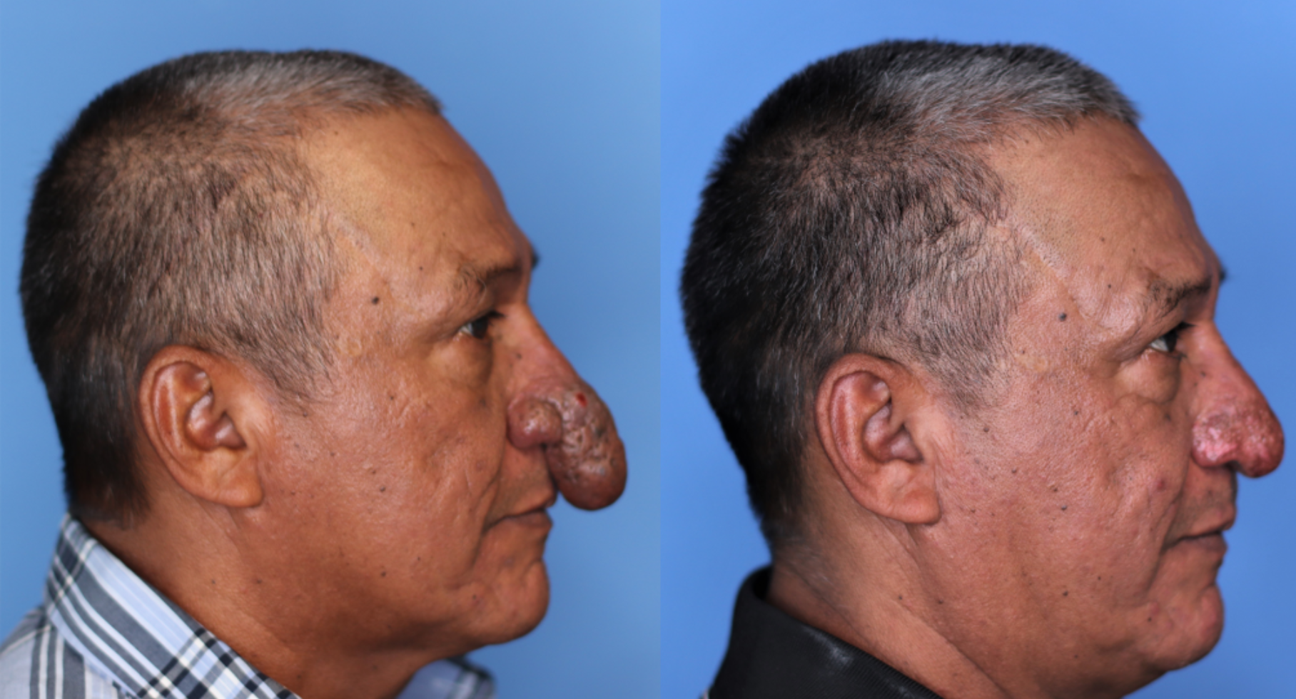 The Remarkable Transformation of Conrado’s Nose