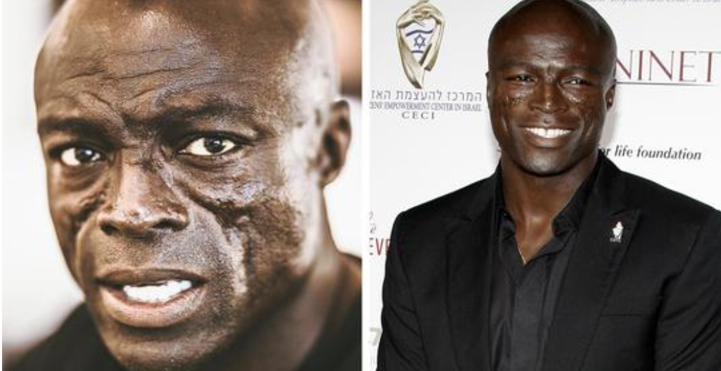 Seal’s had his trademark face scars for more than 30 years – this is why