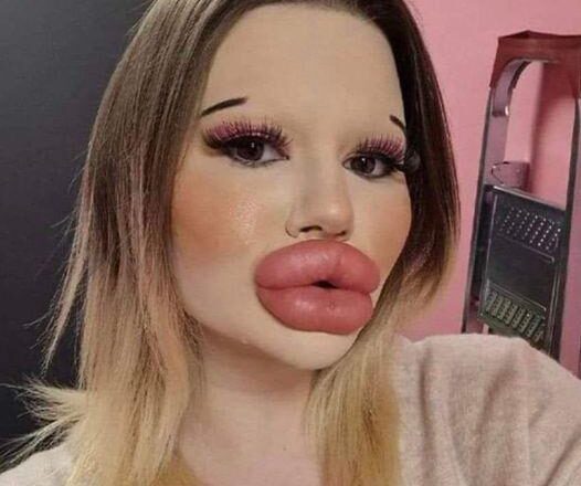 24-year-old Bulgarian woman wants to have the biggest lips in the world